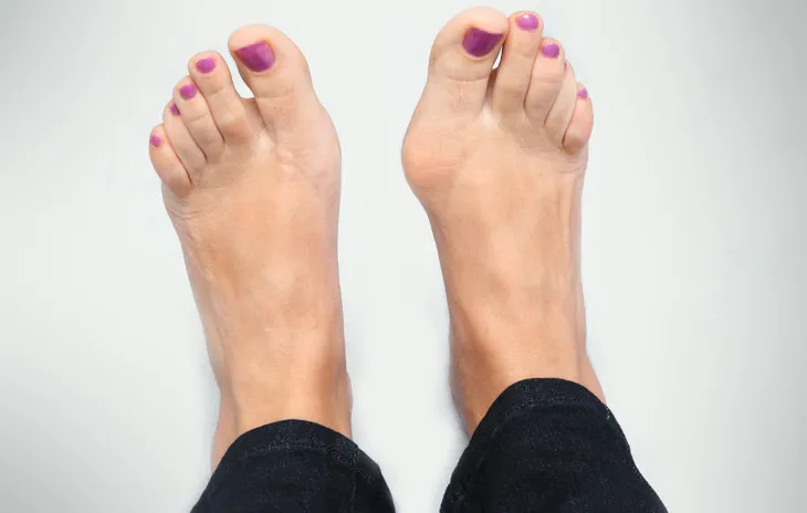 szkodliwe obuwie haluksy