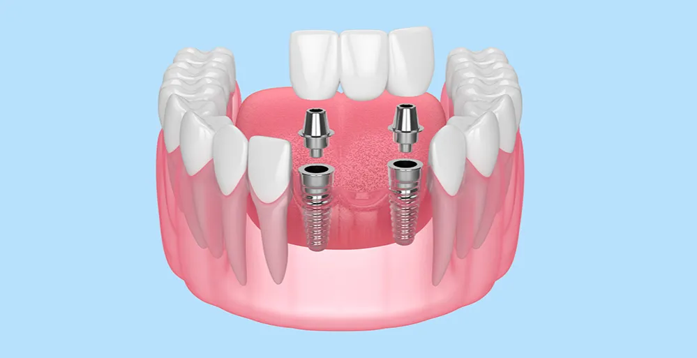 różne rozwiązania protetyczne implanty mosty protezy