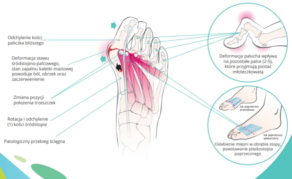 Techniki operacyjne haluksa
