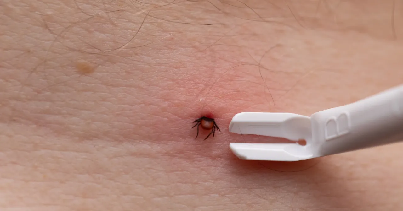 kleszcz w skórze