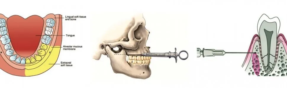 skład znieczulenia stomatologicznego schemat
