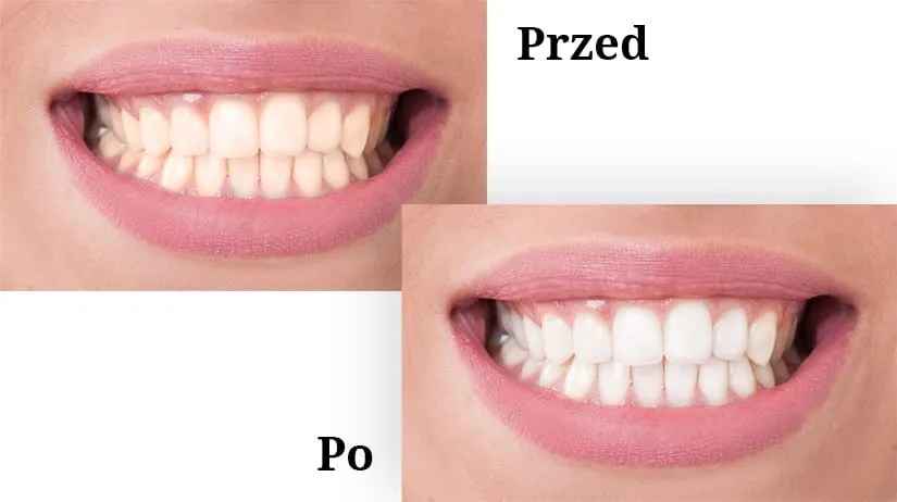 Produkty do domowego wybielania zęb&oacute;w i gabinetowe