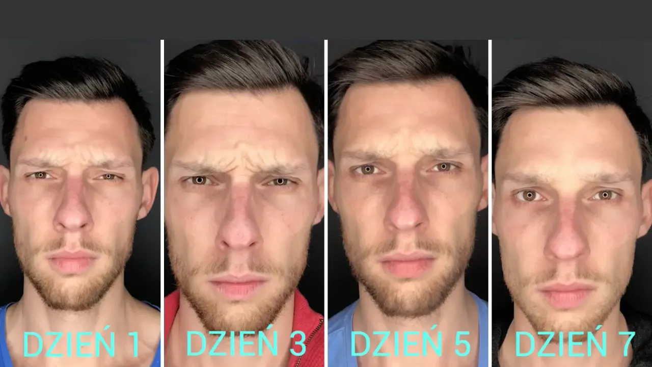 botoks lwia zmarszczka efekty dzień po dniu