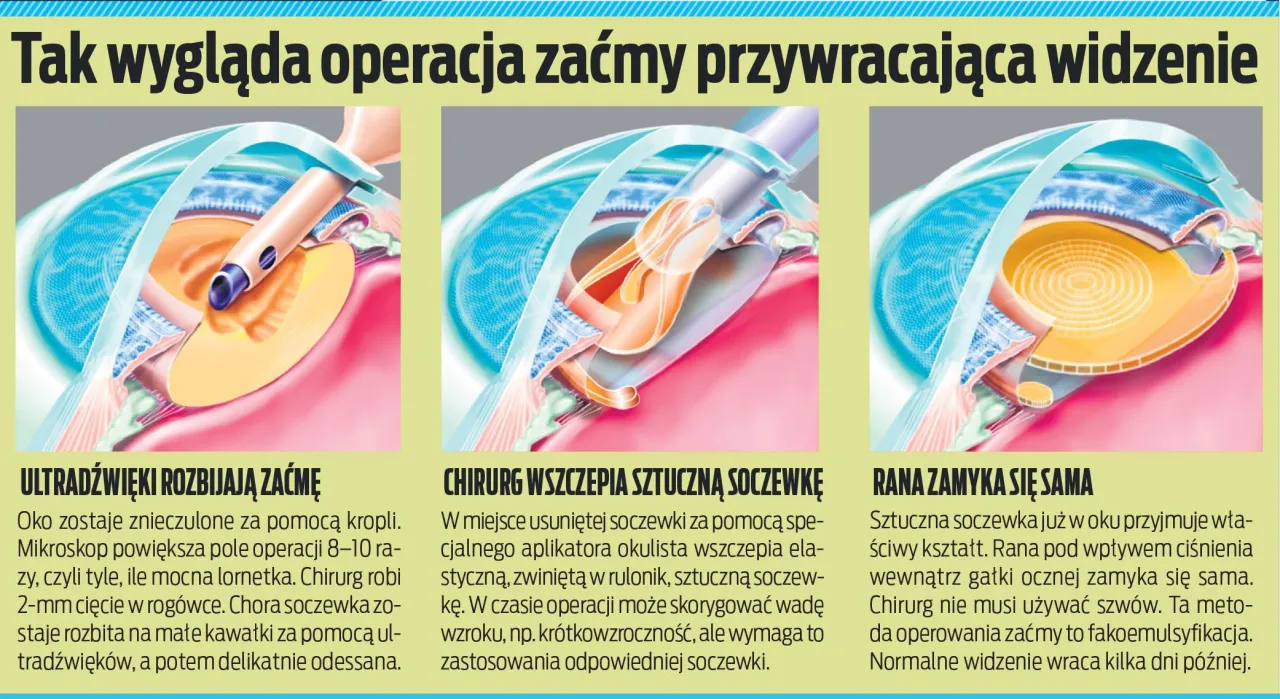 Operacja zaćmy fakoemulsyfikacja schemat