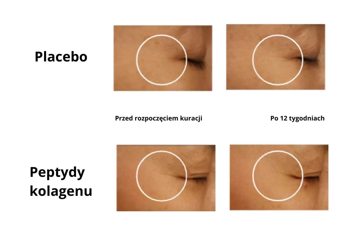 Por&oacute;wnanie sk&oacute;ry pod oczami: placebo vs. peptydy kolagenu. Widoczne zmniejszenie zmarszczek po 12 tygodniach stosowania peptyd&oacute;w kolagenu.