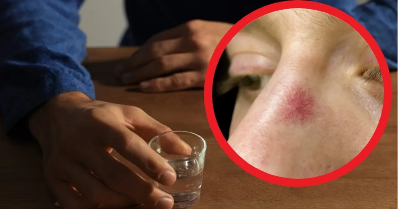 rozszerzone naczynia krwionośne alkohol