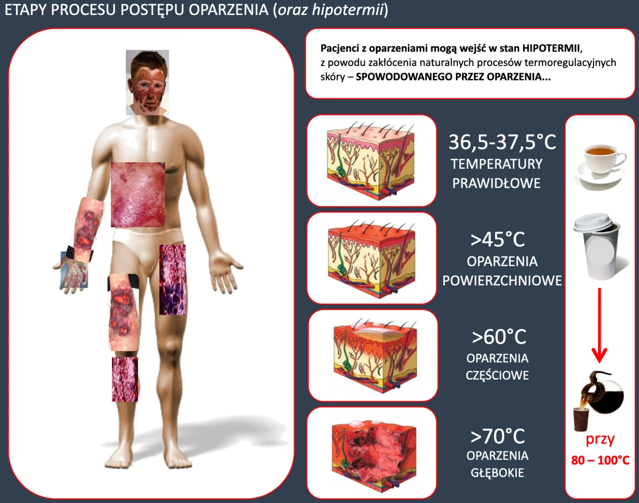 stopnie oparzeń sk&oacute;ra wizualizacja