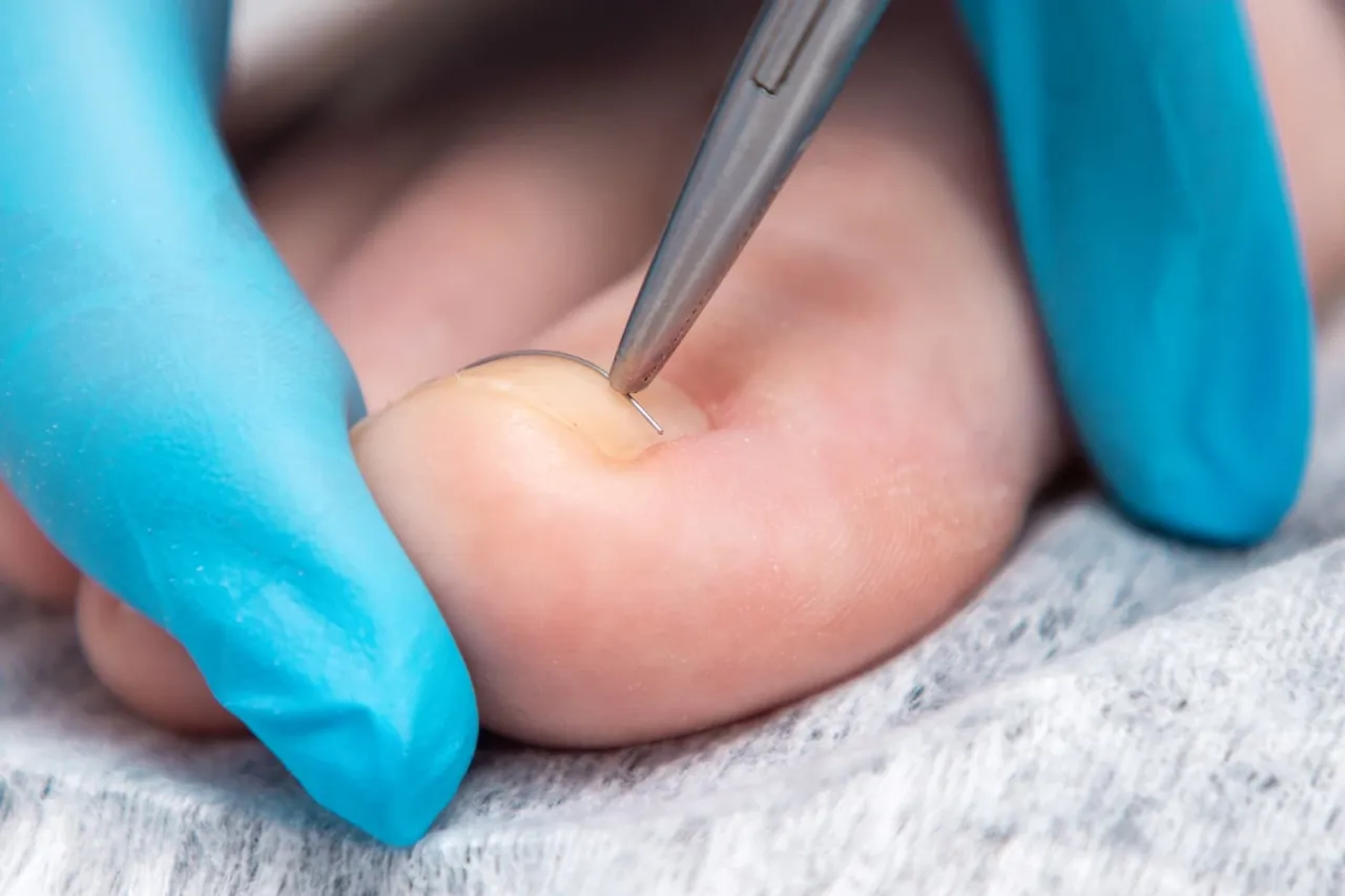 Domowe sposoby na wrastający paznokieć