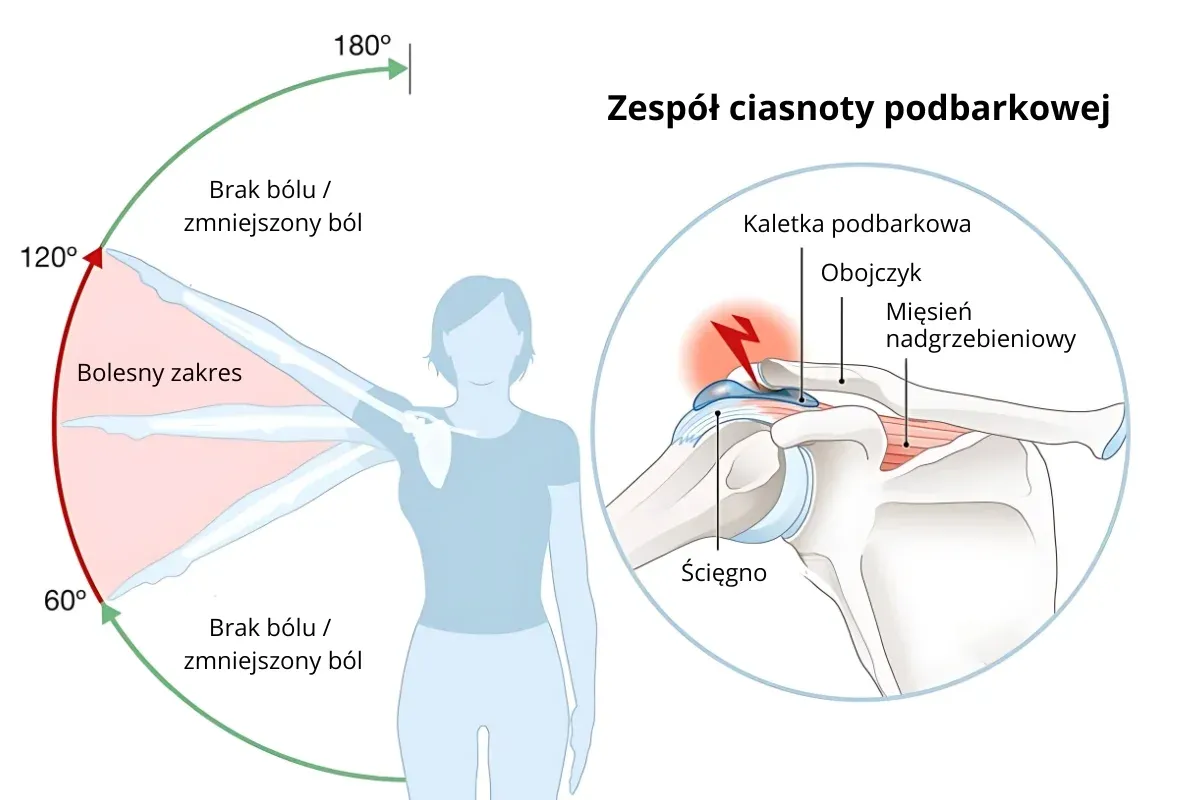 Anatomia barku i zesp&oacute;ł ciasnoty podbarkowej