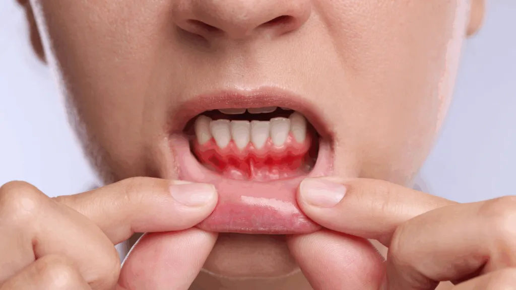 objawy zapalenia dziąseł krwawienie obrzęk