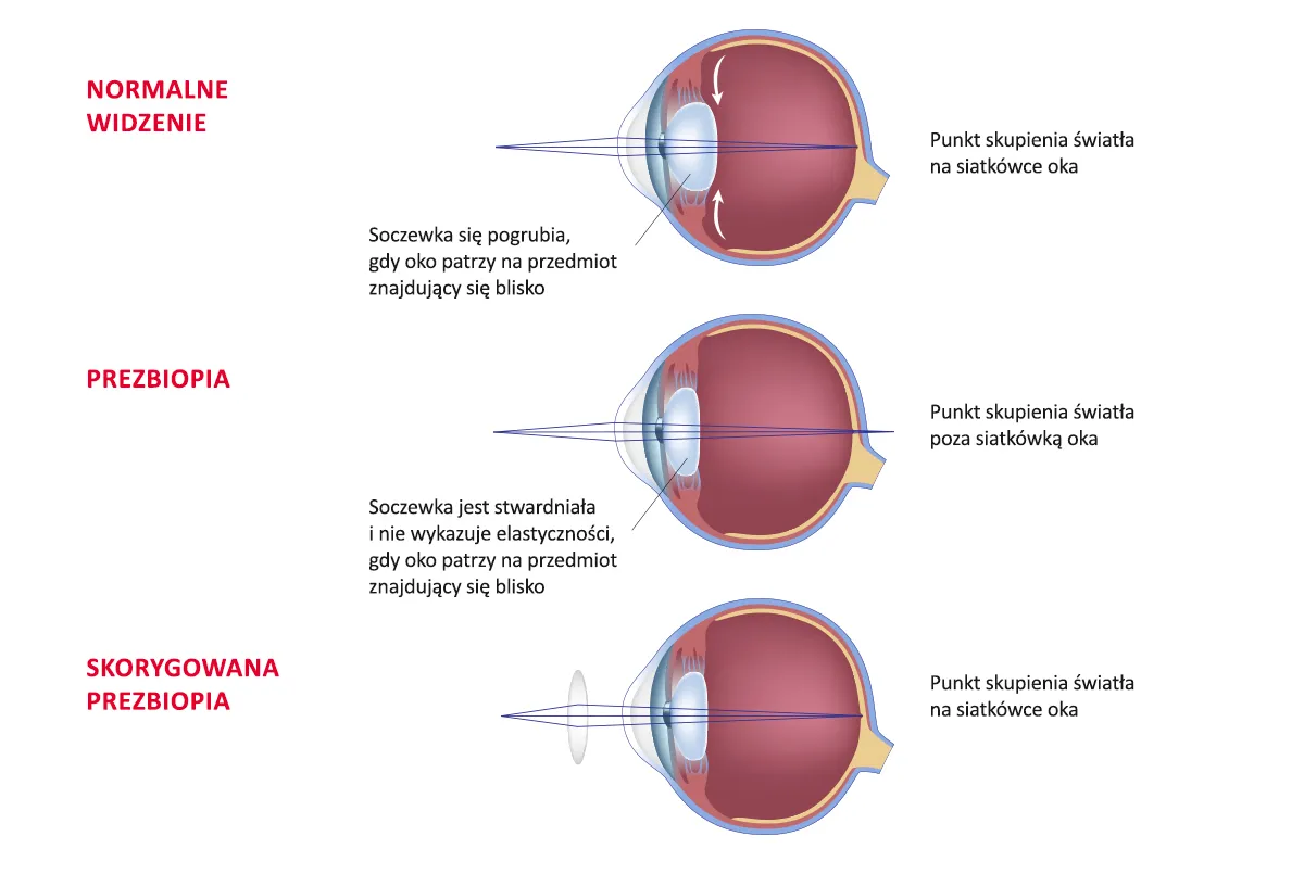 budowa soczewki progresywnej pola widzenia