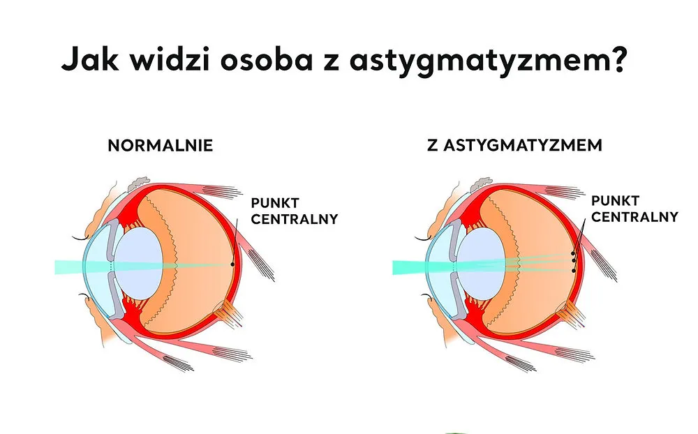 Diagram oka z astygmatyzmem i osią korekcji