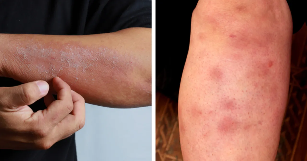 Objawy skórne raka jelita grubego