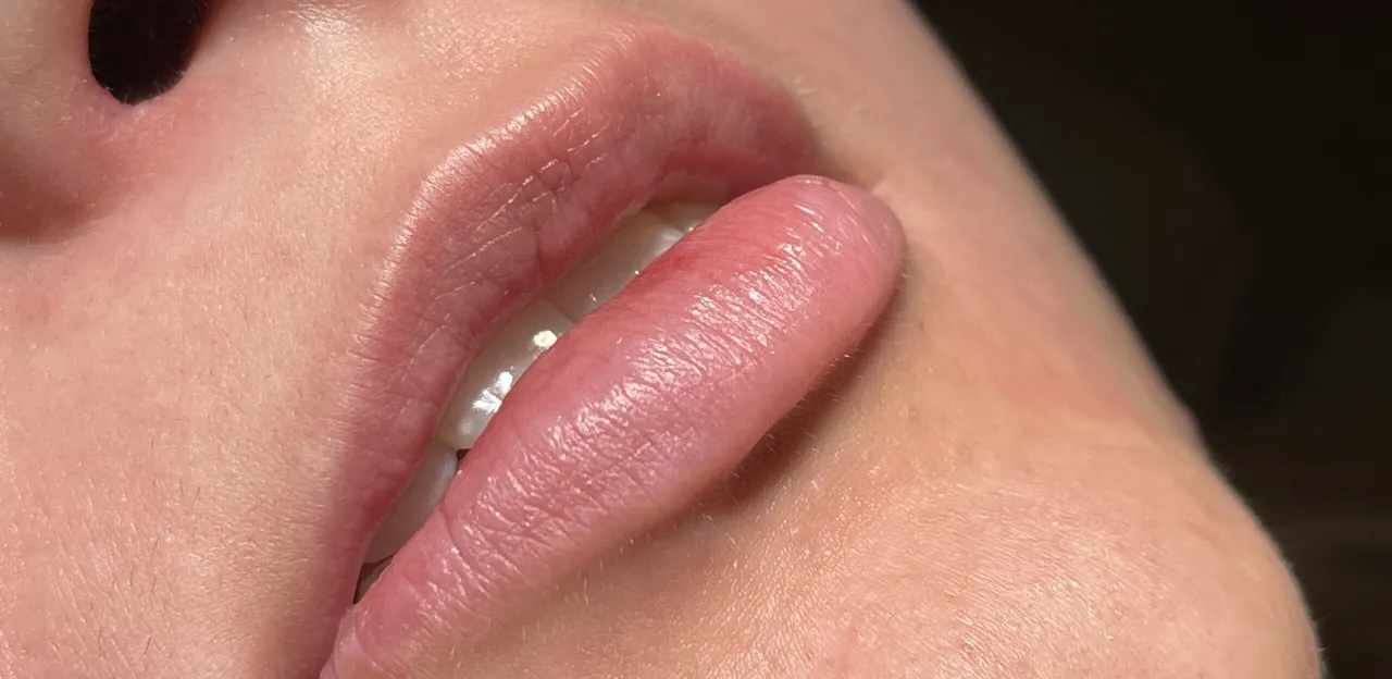 Czego unikać po powiększaniu ust