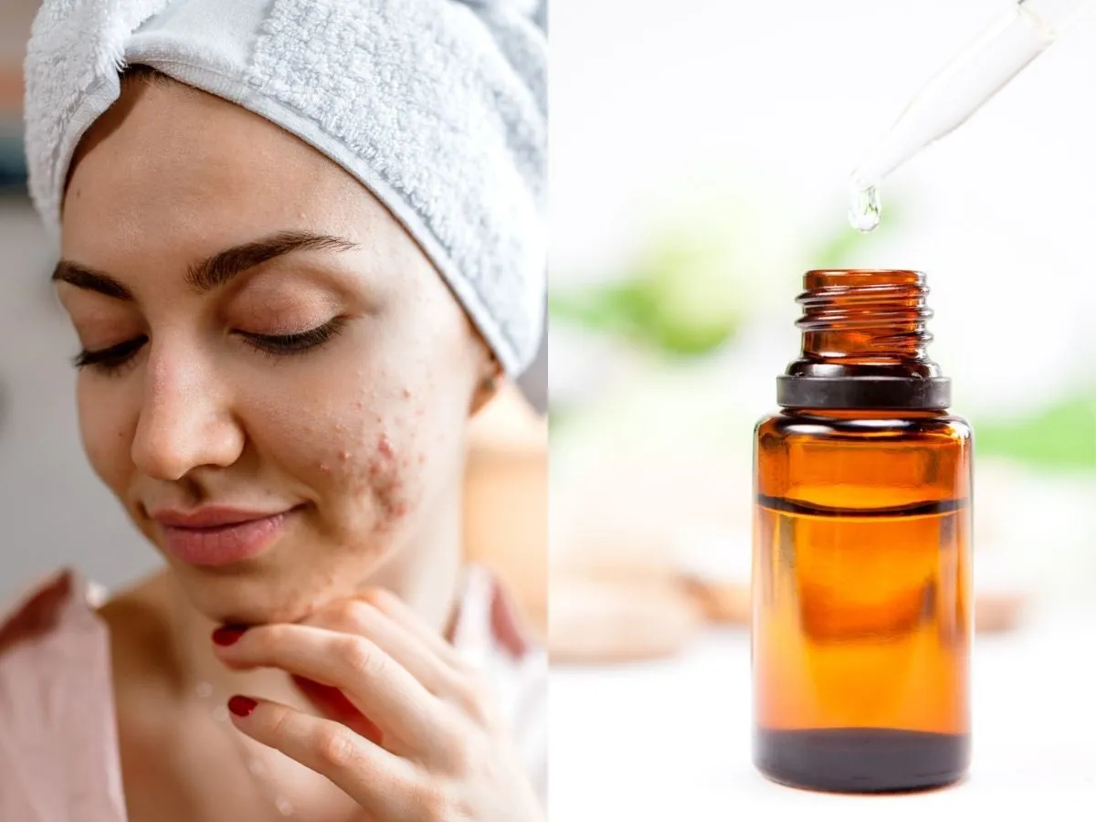 Domowe sposoby na pryszcze, olejek z drzewa herbacianego