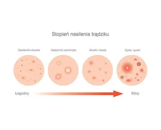 rodzaje trądziku zdjęcia