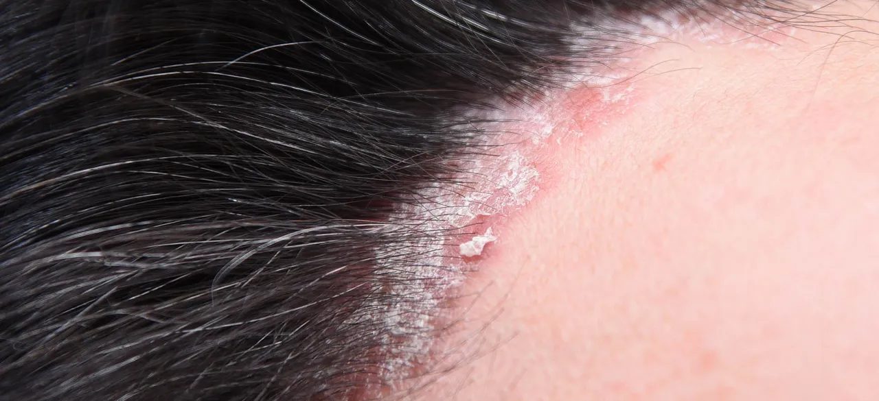 swędzące czoło po czapce przyczyny