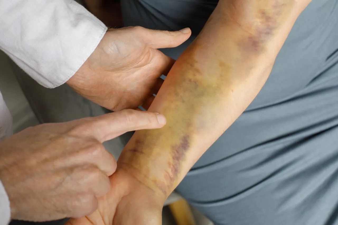 Objawy choroby von Willebranda