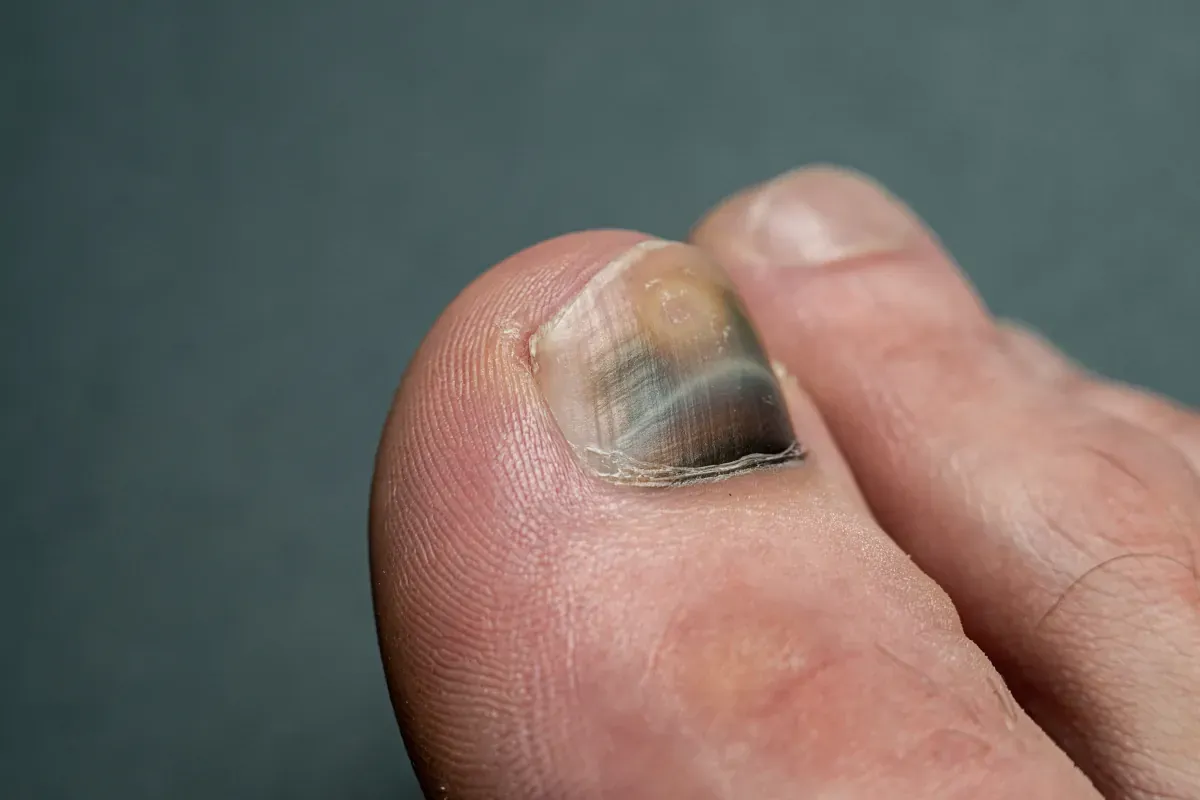 Wizyta u dermatologa paznokcie