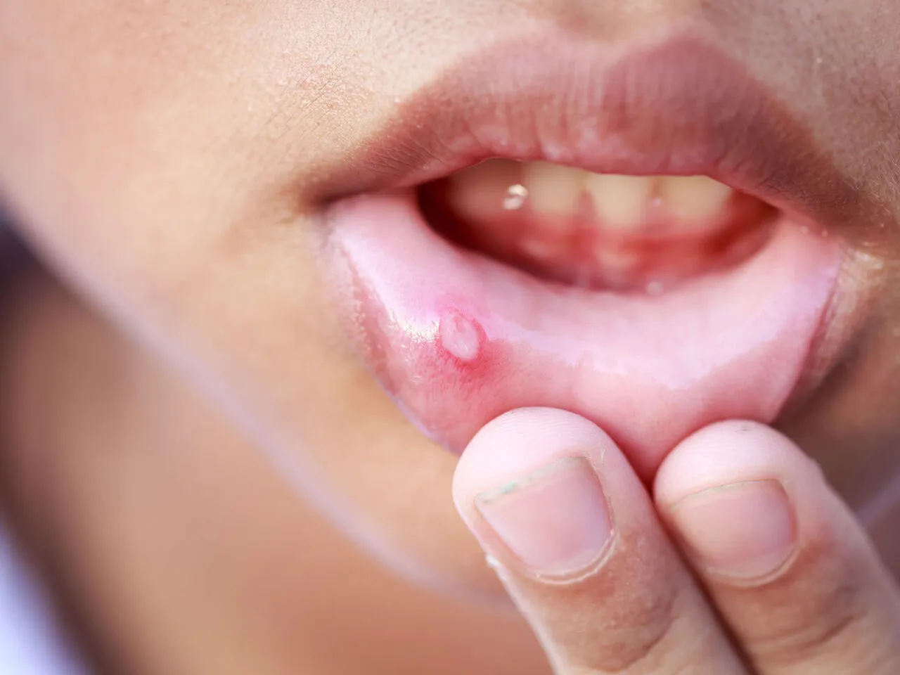 Rodzaje zapalenia jamy ustnej u dzieci - afty, pleśniawki, opryszczka