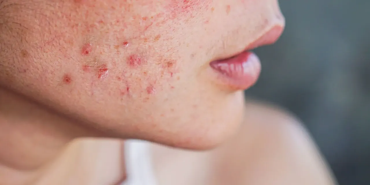 skóra z trądzikiem przyczyny powstawania