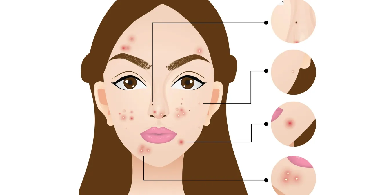 przyczyny pryszczy na czole grafika