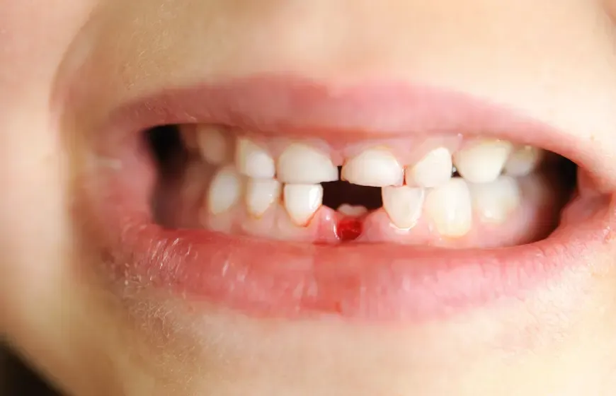 luźny ząb mleczny u dziecka