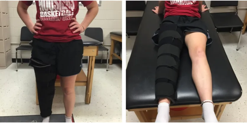 rehabilitacja kolana zwichnięcie rzepki