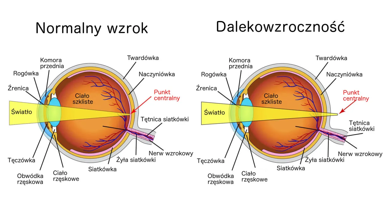 por&oacute;wnanie kr&oacute;tkowzroczność dalekowzroczność schemat
