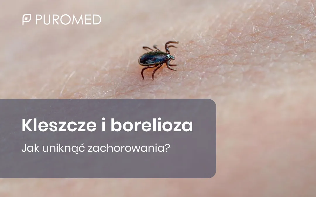 Zdjęcie Jak zapobiec boreliozie - skuteczne metody ochrony przed kleszczami