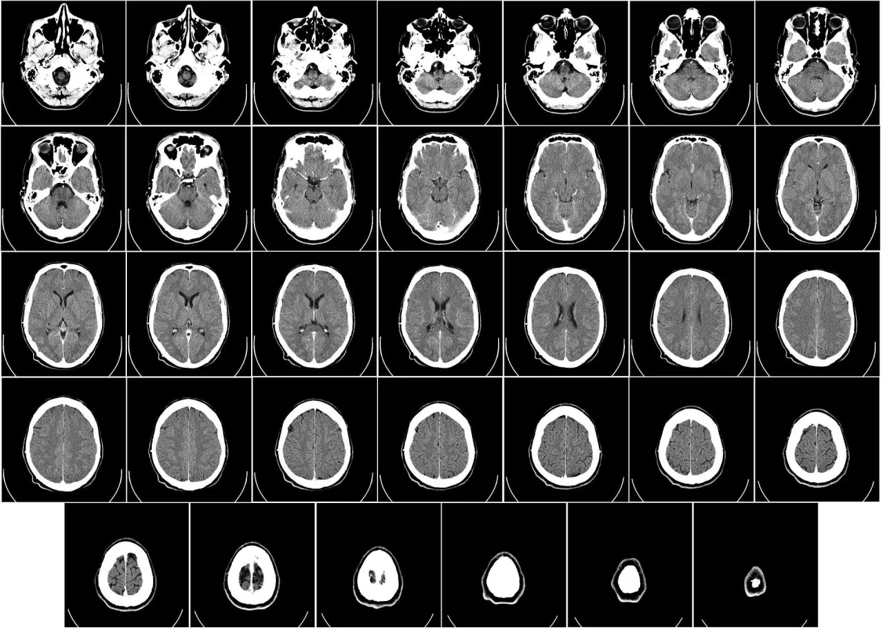 Zdjęcie Ile się czeka na wynik tomografii głowy? Sprawdź czas oczekiwania