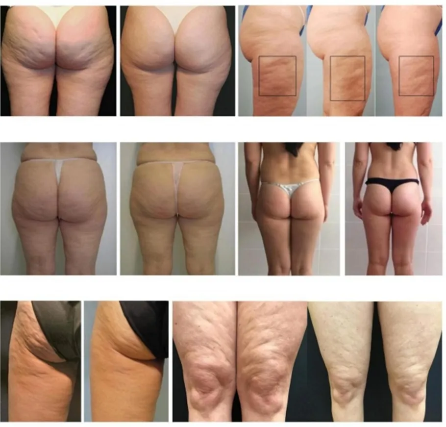 Zdjęcie Skuteczne sposoby na cellulit, które naprawdę działają i przynoszą efekty