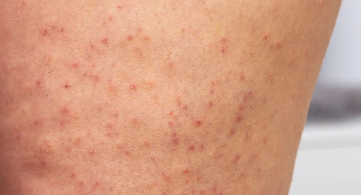 rogowacenie okołomieszkowe skóra truskawkowa