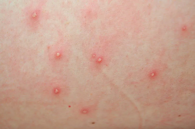 ospa wietrzna pierwsze objawy u dziecka