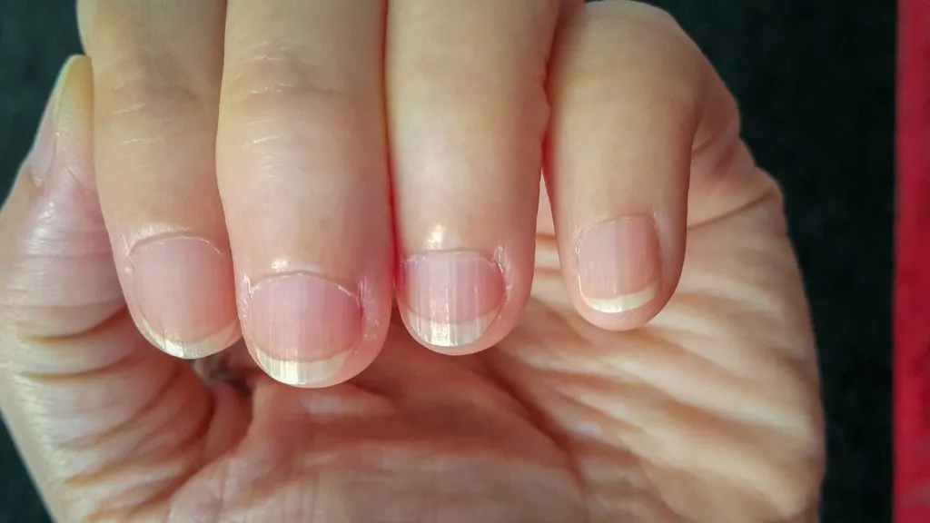 objawy niedoboru biotyny wypadanie włosów łamliwe paznokcie