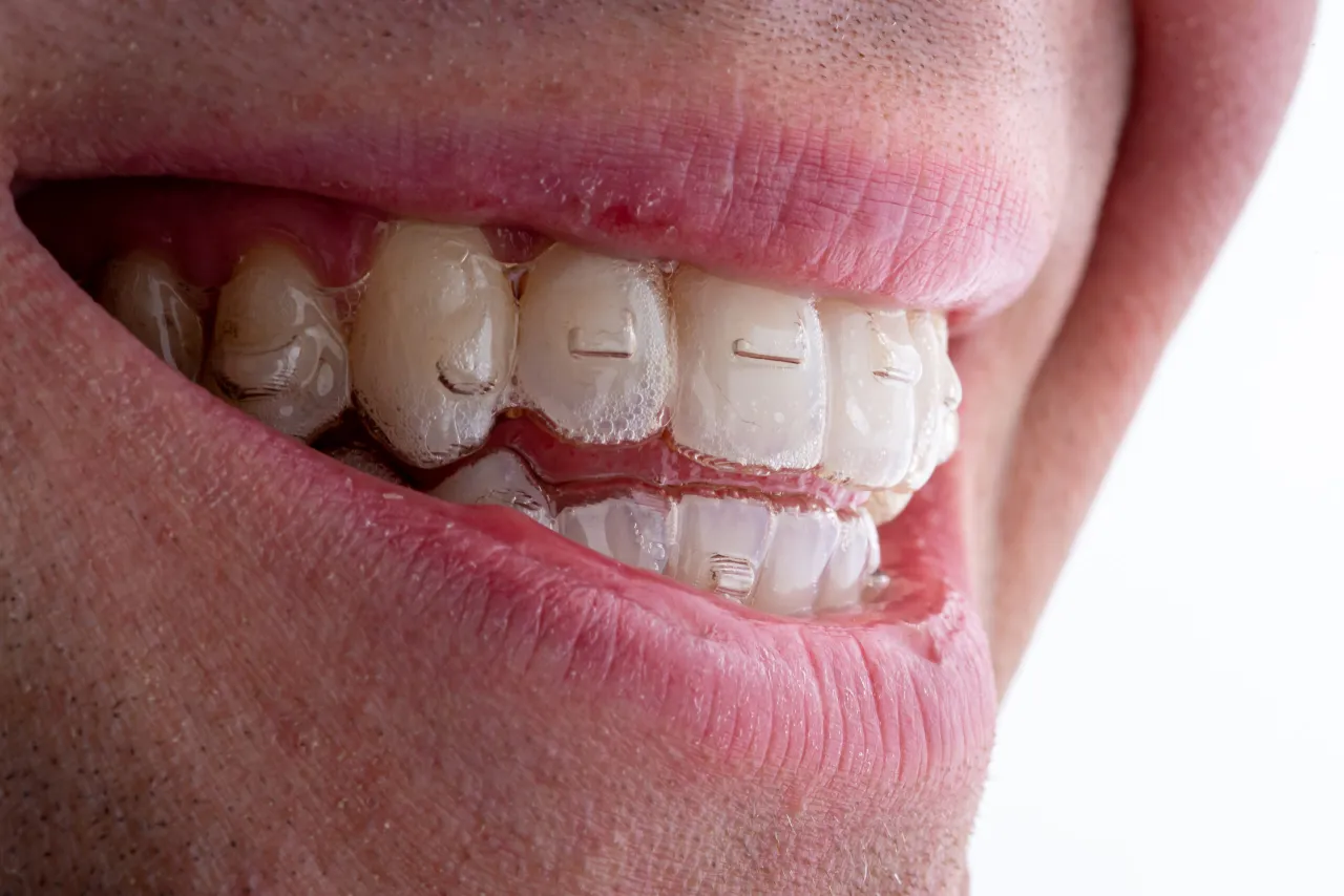 koszt invisalign w polsce