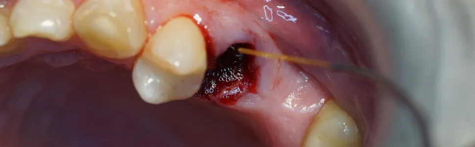 skrzep krwi w zębodole po ekstrakcji