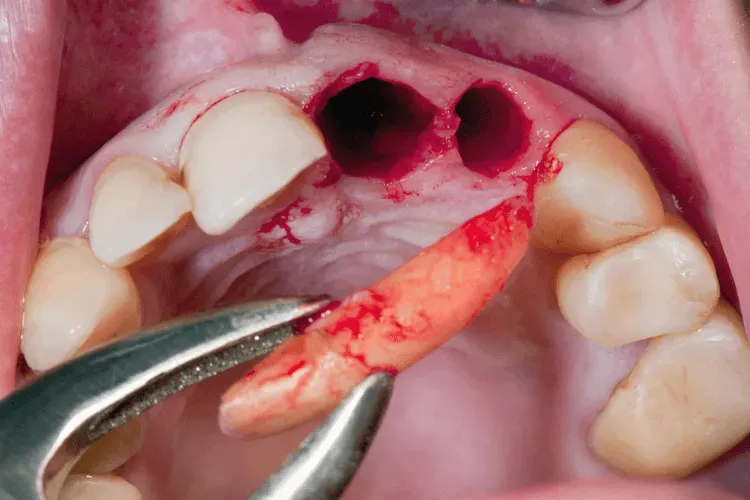 suchy zębodół vs zdrowy zębodół porównanie
