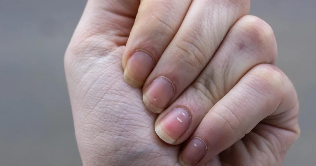 Rodzaje leukonychii na paznokciach