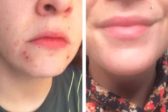 Serum z witaminą C efekty przed i po