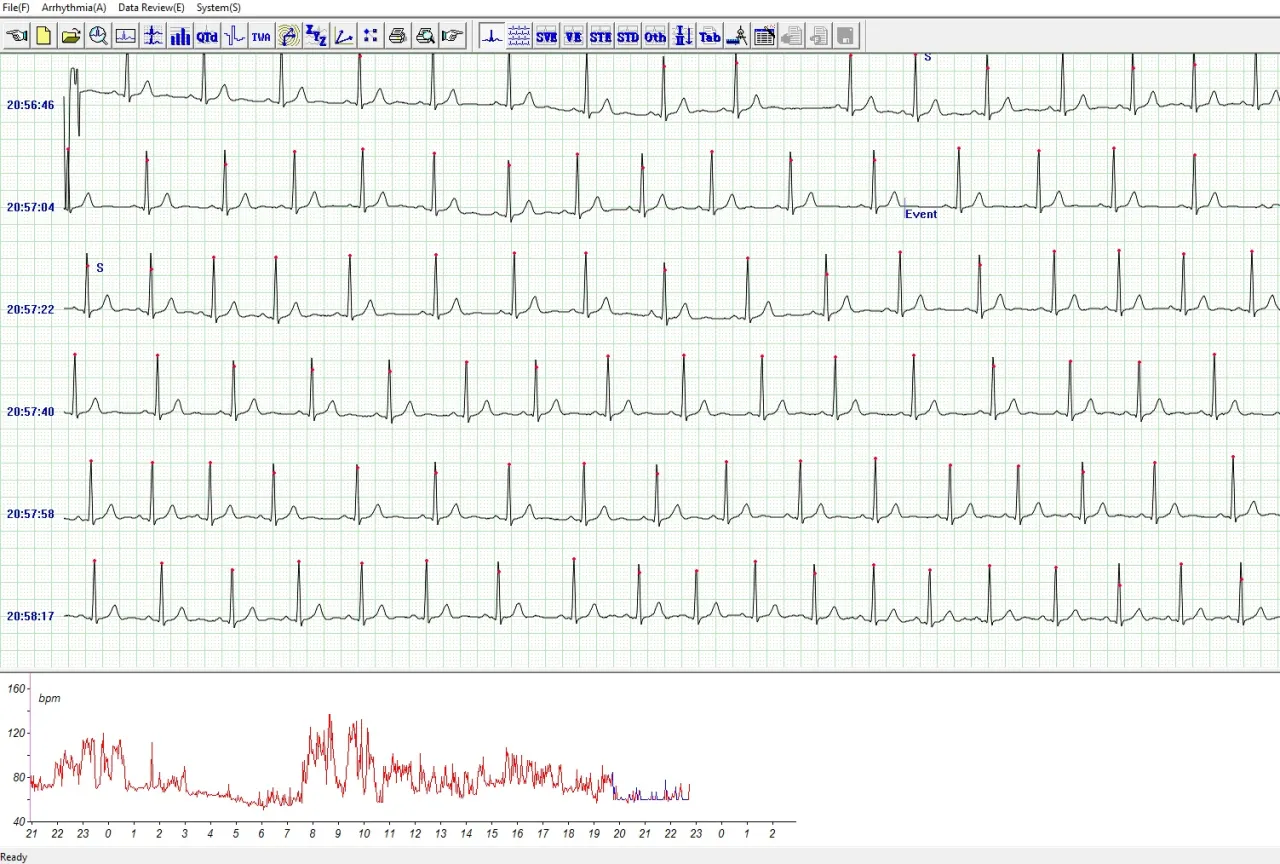 przykładowy zapis ekg