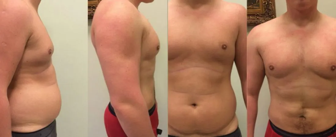 liposukcja laserowa ultradźwiękowa wodna porównanie