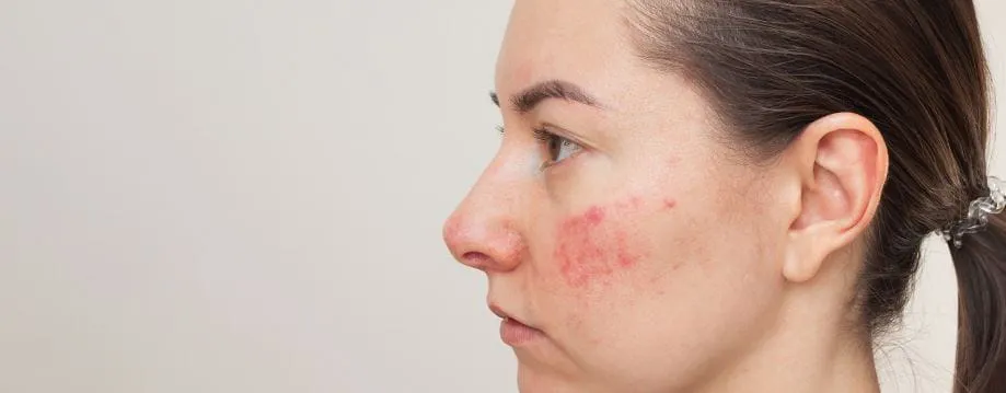 Pflegeroutine Couperose Schritt f&uuml;r Schritt