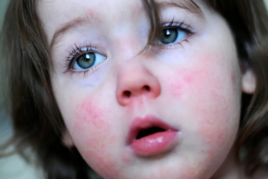 Szkarlatyna objawy wysypka na skórze dziecka