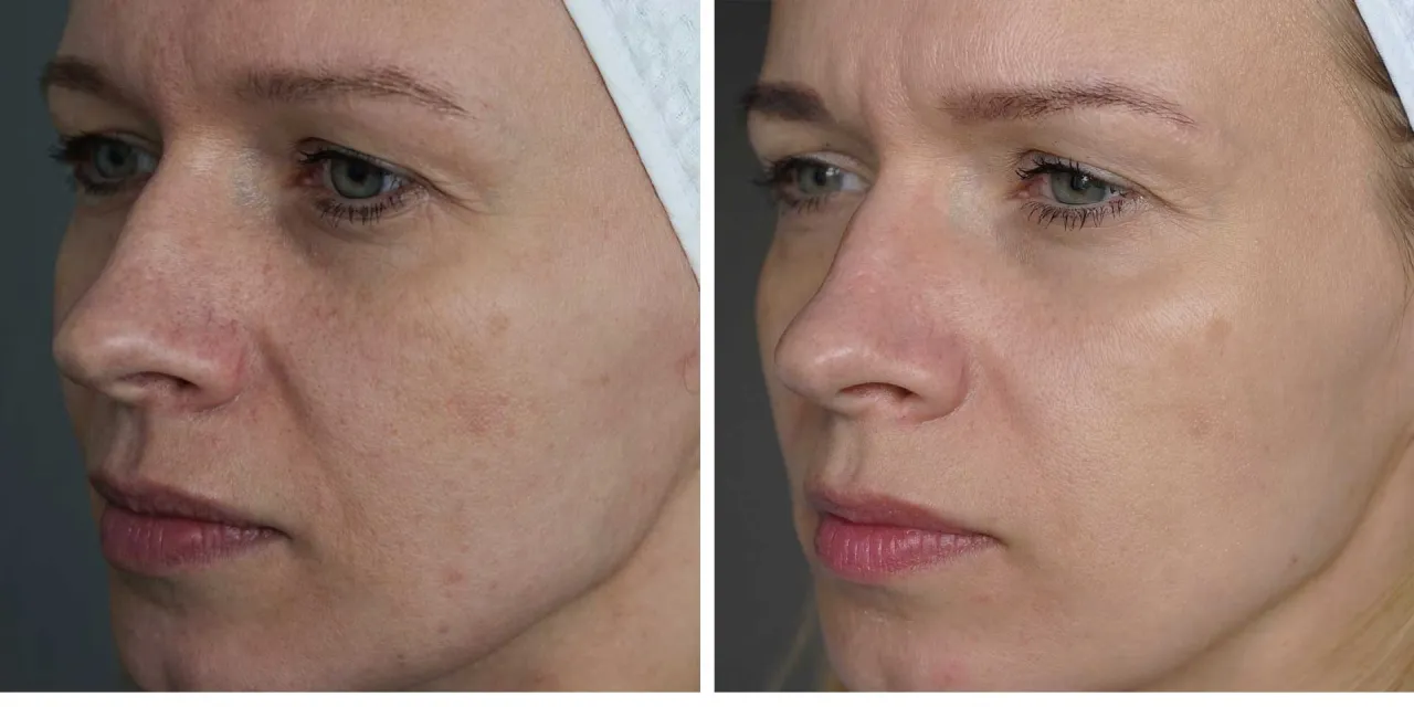 Przed i po zabiegu laserem frakcyjnym: redukcja przebarwień, naczynek i drobnych zmarszczek. Laser frakcyjny na co pomaga? Na odmłodzenie sk&oacute;ry!