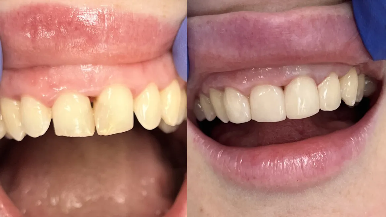 profesjonalne wybielanie zębów gabinet