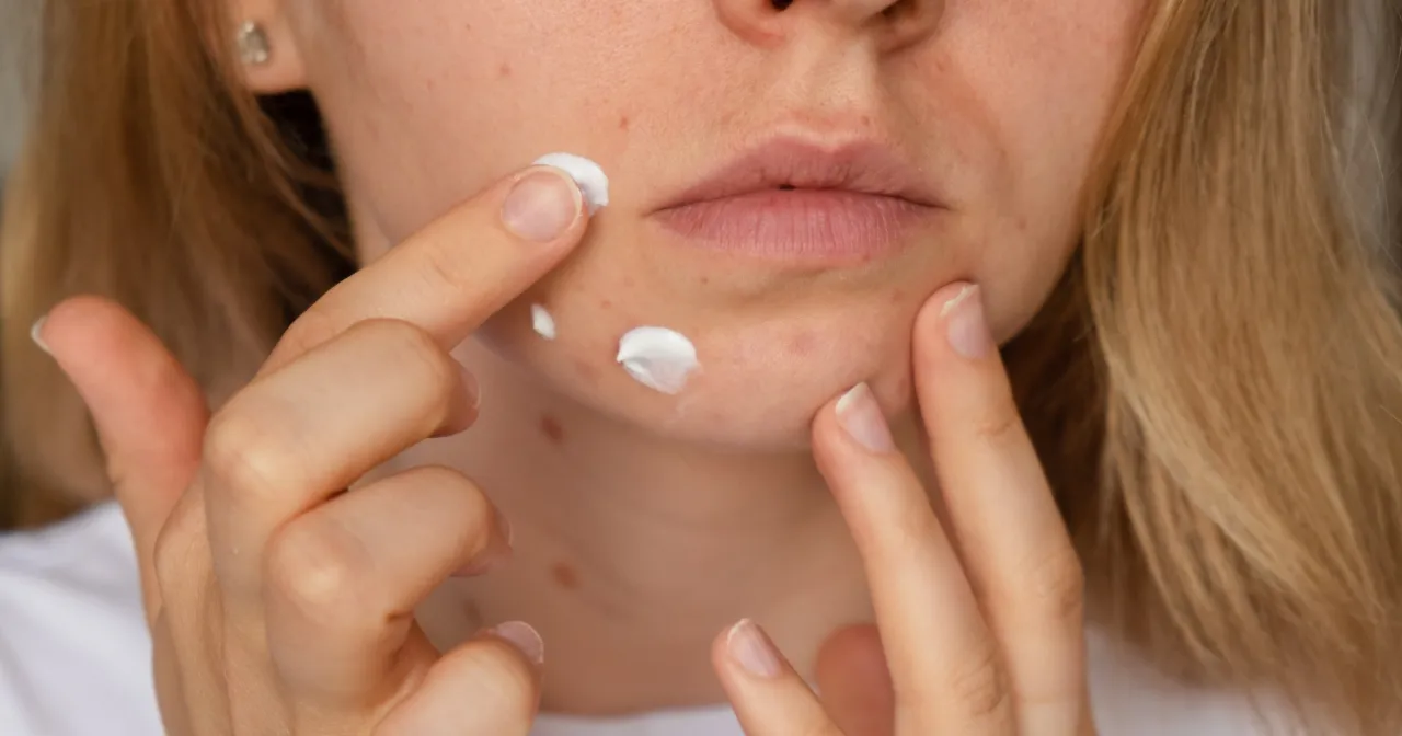 Apteczne preparaty na pryszcze, kwas salicylowy, niacynamid, plasterki hydrokoloidowe