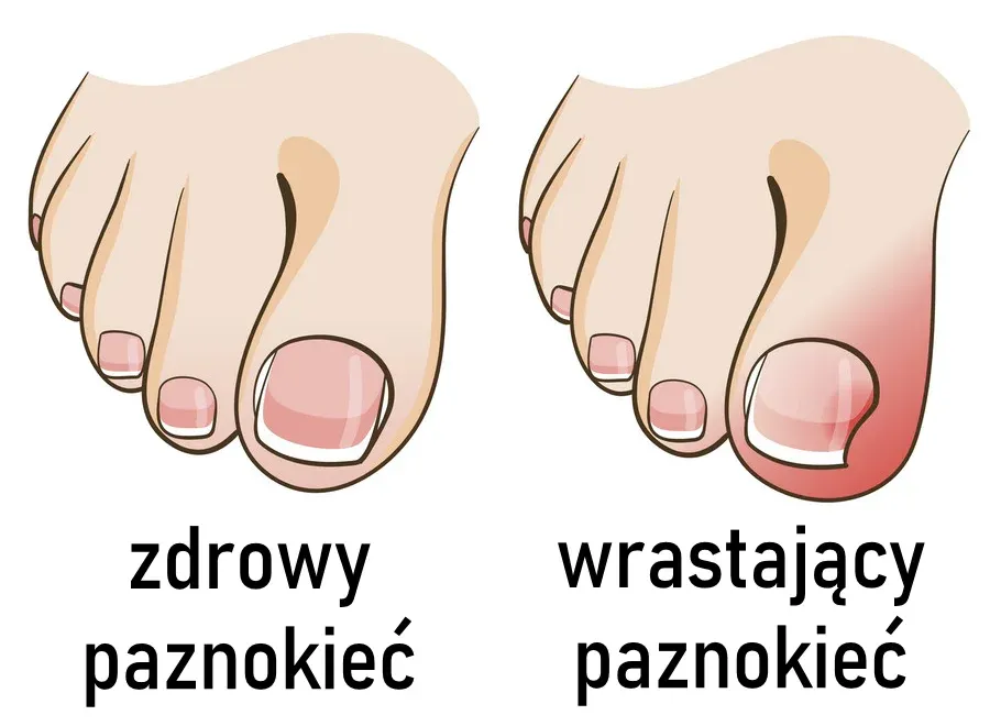 prawidłowe obcinanie paznokci u stóp