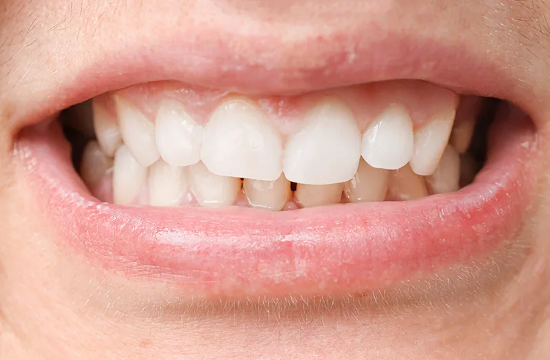 prawidłowy zgryz, okluzja zębów