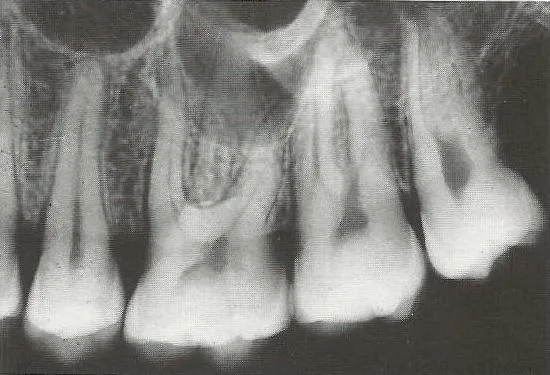 rentgen zęba zdjęcie punktowe